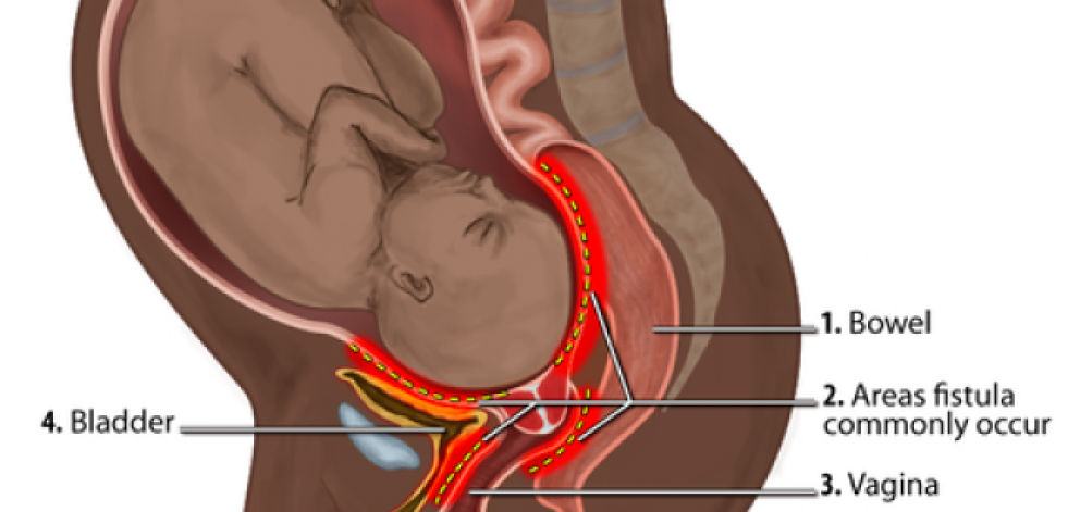 La fístula obstétrica, una lesión que afecta a mujeres en situación de pobreza