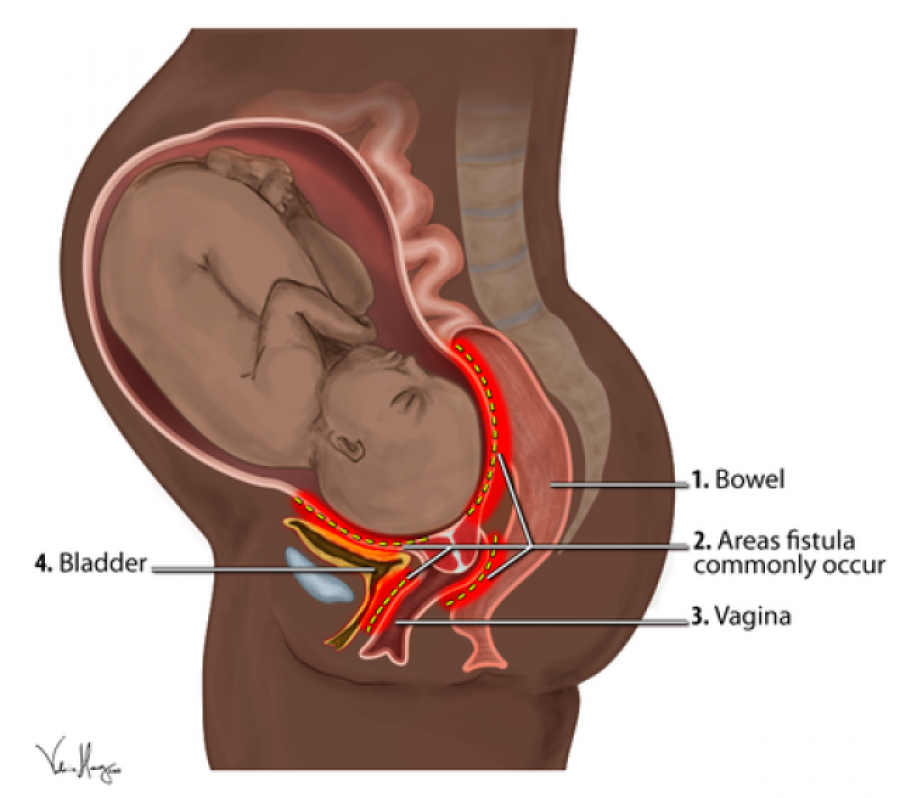 La fístula obstétrica, una lesión que afecta a mujeres en situación de pobreza