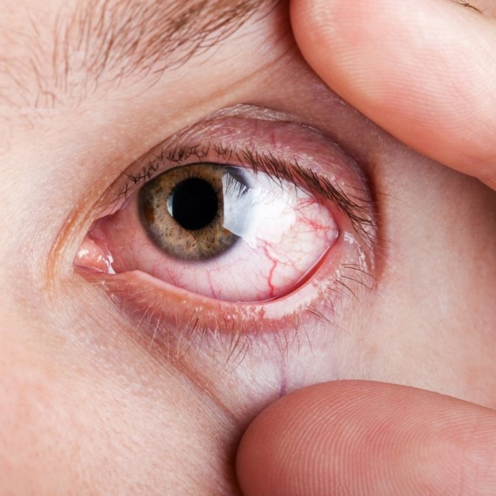 Consejos para aliviar los sintomas del ojo seco